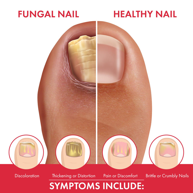 Fungal Shield Professional Antifungal Treatment, Maximum Strength Tolnaftate 1% Liquid, 1.5 fl oz Clinical Size