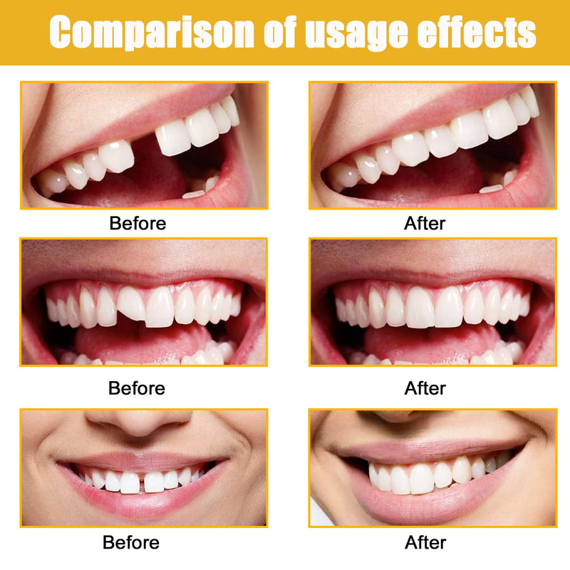 [Australia] - lankai Temporary Tooth Repair, Dentures, Temporary Teeth, Dentures DIY, Temporary Tooth Repair Set, Thermal Adhesive Beads for Missing Broken Tooth Fake Tooth Veneer (100g) 