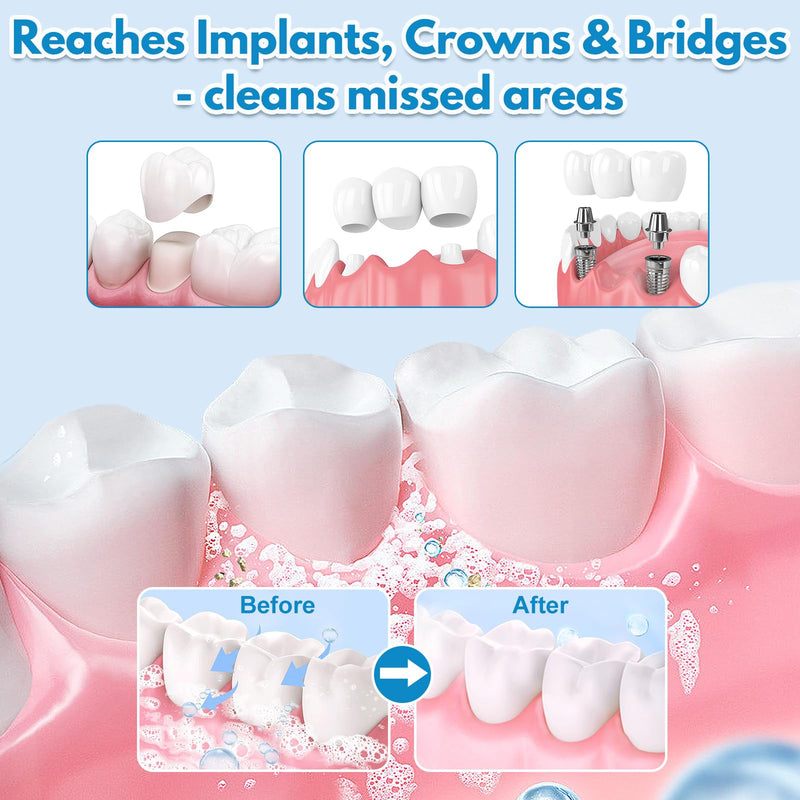 Dental Implant Cleaner, Cleans & Whitens Implants, Crowns, Bridges & Veneers, Freshens Breath & Supports Oral Health, Dental Bridge Cleaner Foam Bring Your Smile Back, 60ml