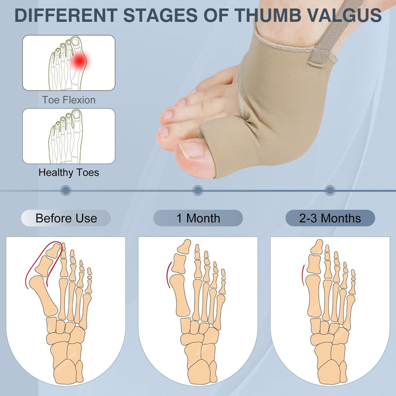 [Australia] - 2PCS Bunion Corrector for Women & Men, Big Toe Straightener with Splint & Pads, Comfortable & Breathable for Day/Night Support, Hallux Valgus Pain Relief Non-Slip Socks Beige 1 