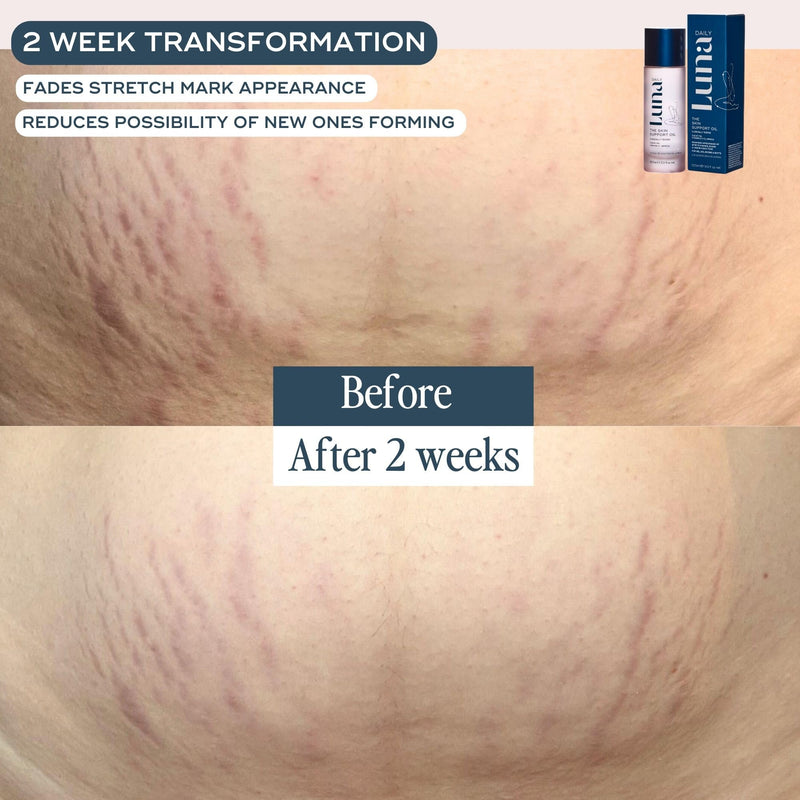 [Australia] - Luna Daily Stretch Mark Body Oil | Hydrating Treatment for Scars, Discoloration & Uneven Skin Texture | Vitamin C & Coconut Oil Nourish Dry Skin | Clinically Proven, Pregnancy Safe for Women, 300ml 