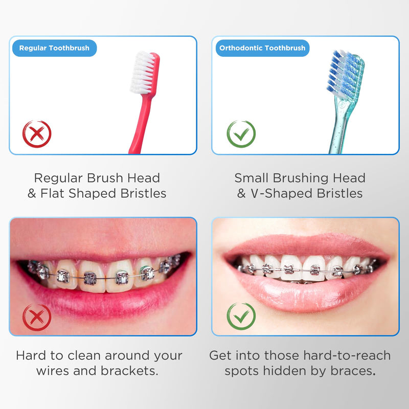 [Australia] - V-Shaped Orthodontic Toothbrush for Braces, with 6 Interdental Brushes, Soft Bristles, 6 Count V Shaped (w/ Interdental Brushes) 