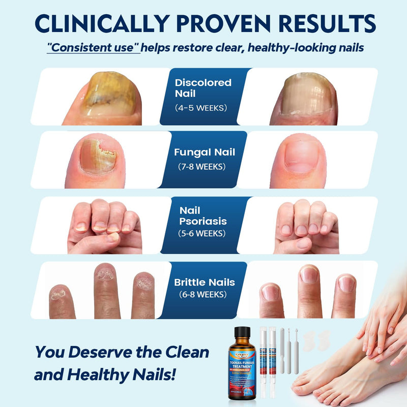 Toenail Fungus Treatment Extra Strength, Nail Fungus Treatment for Thick, Discolored Fungi Nails - 25% Undecylenic Acid All-in-One Kit with 30ML Fungi Nail Solution, 2 Nail Repair Pens