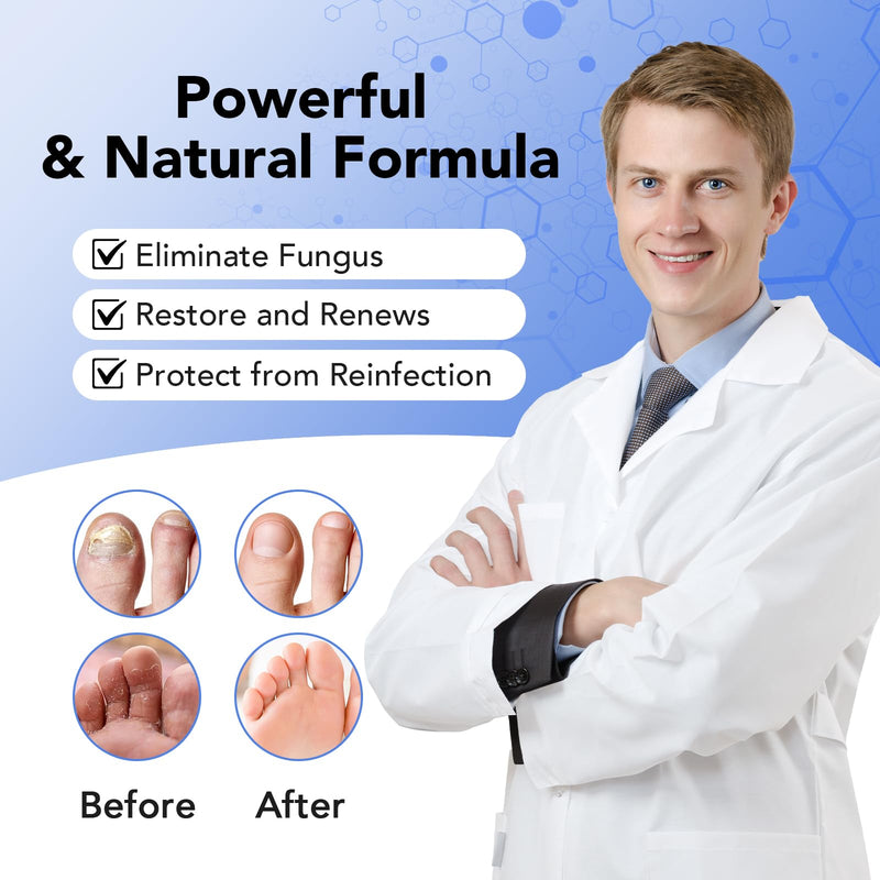 Toenail Fungus Treatment Extra Strength, 30ML Fungal Nail Treatment for Thick, Yellow, Discolored Nails, 4 Weeks Toe Nail Fungus Treatment, Ingrown Toenail, Athletes Foot, Nail Growth & Strengthener