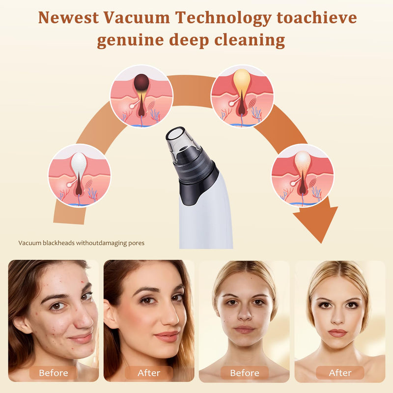Blackhead Remover Vacuum - Powerful Pore Vacuum for Cleansing, Blackhead Extractor with 3 Adjustable Suction Levels, 4 Blackhead Removal Tools, USB Rechargeable，Suitable for Women and Men