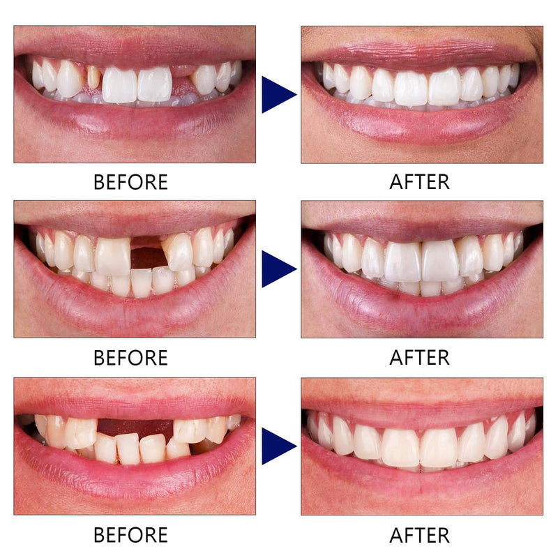 [Australia] - Tooth Repair Kit, Moldable False Teeth, Tooth Replacement Missing Teeth, Teeth Filling Kit Permanent with 4 Dental Tool, Tooth Repair Kit for Broken Teeth, Temporary Tooth Filling Kit, Moldable Teeth 
