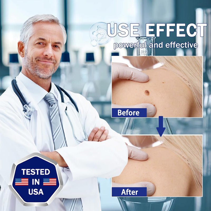 [Australia] - LIGUID WART Remover,Fast Action Wart Remover,Wart Liquid with Salicylic Acid, Plantar Wart, Common Wart, Flat Wart,Corn, Callus,1floz(30mL) 1 bottle 