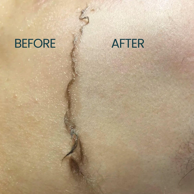 Dermaplane Kit for Women with Dry Skin - Face Shaving Oil and Razor Set - Non Comedogenic, Fragrance Free, Natural and Lightweight by Ouiloe For Dry Skin 4 Fl Oz (Pack of 1)