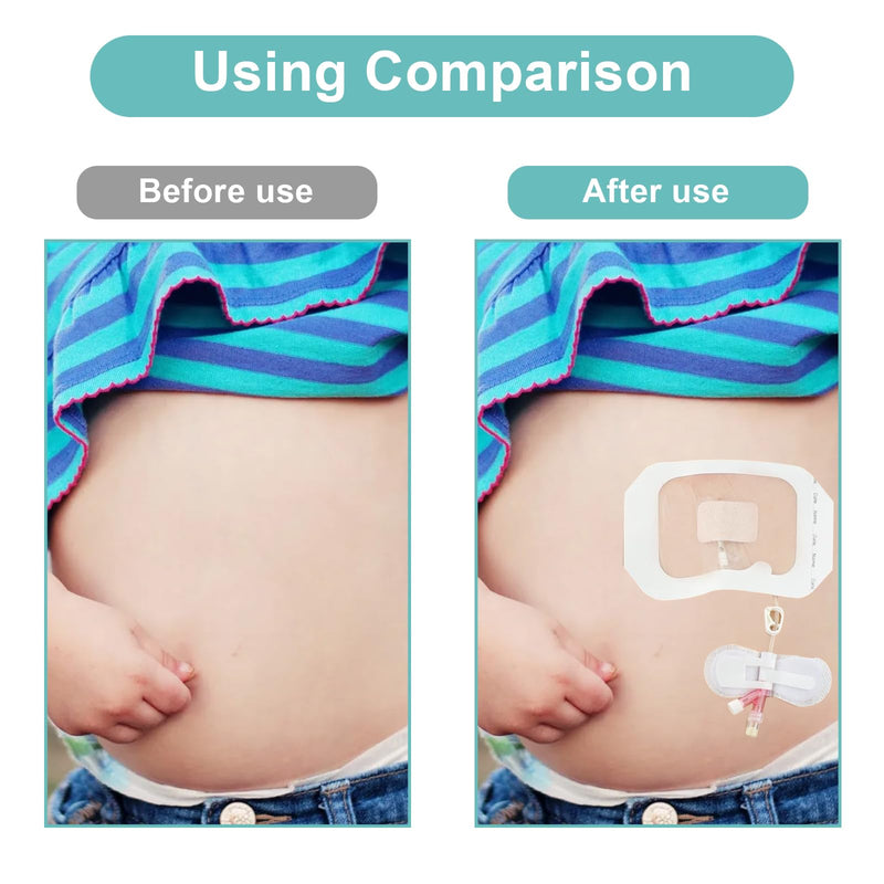 [Australia] - Catheter Stabilization Device,Feeding Tube Holder,Self Adhesive Catheter Holder Patch Dressing (10 Pack) 10 Pack 