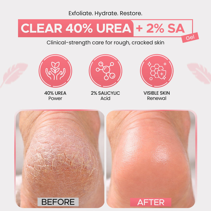 CLEAR Urea Gel 40 Percent Plus 2% Salicylic Acid (4oz) Made in USA | Urea Foot & Hand Cream Softens Cracked Heels & Dry Skin with Tea Tree & Coconut Oil - Callus & Corn Treatment Red 4 Fl Oz (Pack of 1)