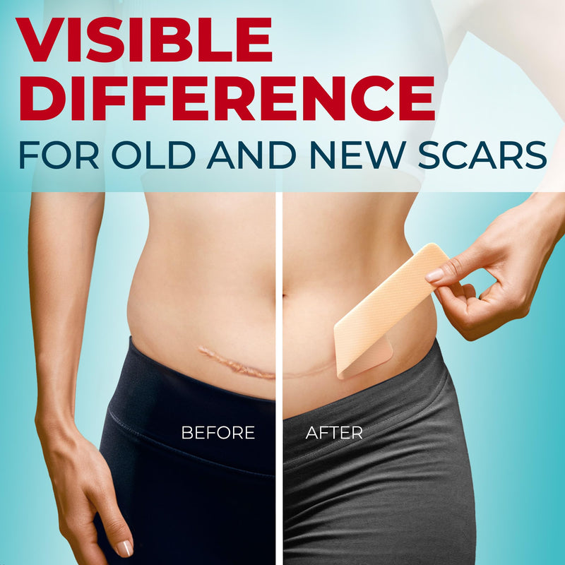 [Australia] - Medical Grade Silicone Scar Tape - 1.6‚Äùx150‚Äù - Visible Difference on Keloid & –°-Section - Reusable Silicone Scar Sheets - Easy to Use Beige 150"x1.6" 