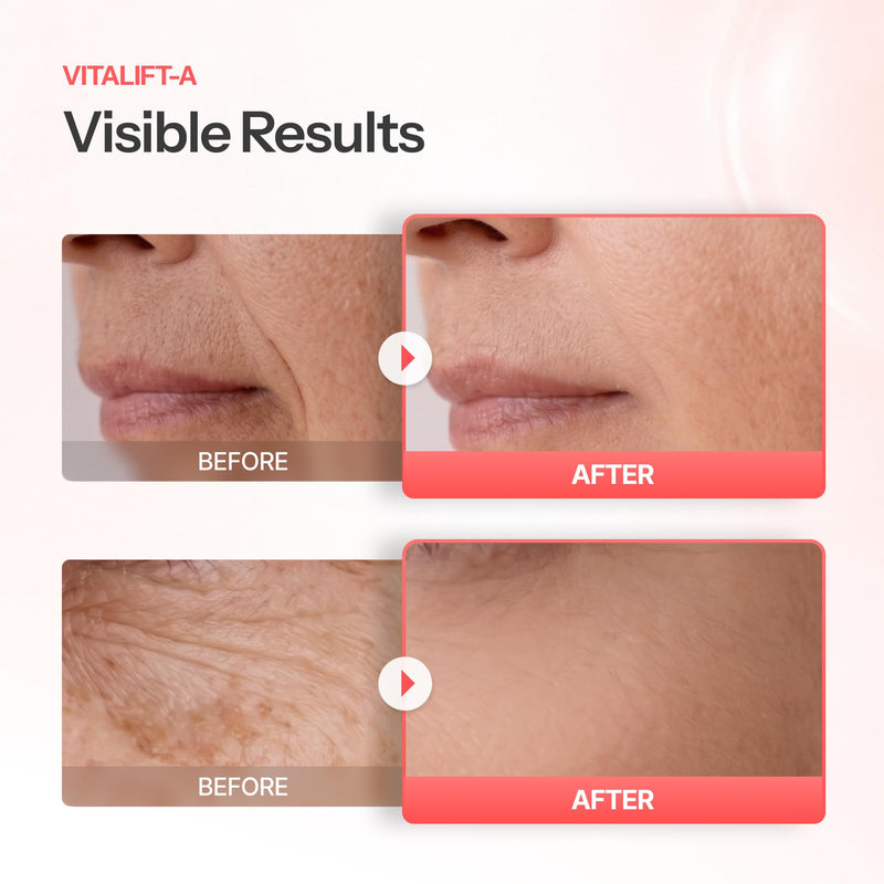 Dr.Different VITALIFT-A Retinal 0.05% - Anti-Aging And Anti-Wrinkle Night Treatment For Lifting And Firming-Face Moisturizer Cream With Vitamin A & Hyaluronic Acid, 0.7oz. Retinal 0.05% 0.7 Ounce (Pack of 1)