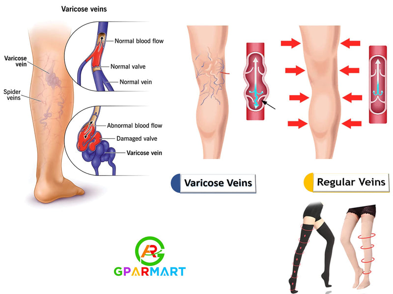 [Australia] - GPAR PREMIUM Medical compression stockings class 2, unisex, 23-32 mmHG, toe-closed thigh-high stockings for varicose veins, edema, leg pain, thrombosis XL Black 