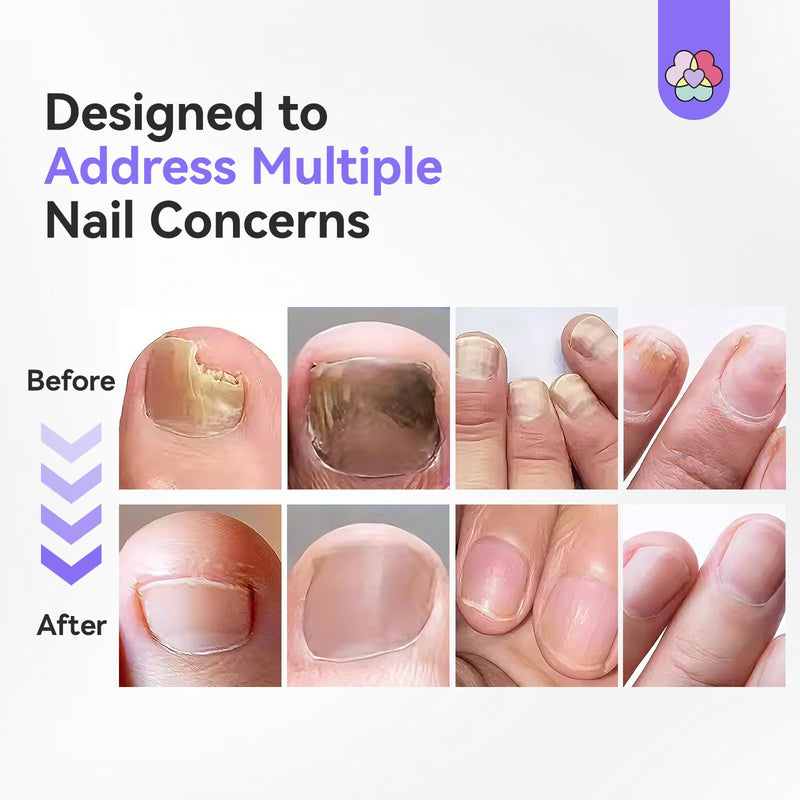 SAVILAND Toenail Fungus Treatment Pen 25% Undecylenic Acid &1% Tolnaftate | FSA-HSA, Precision Pen, Dries Clear No Mess, Vitamin E & Tea Tree Oil, Thick Damaged Nail Repair, For Travel, Work & Daily 1 Count (Pack of 3)