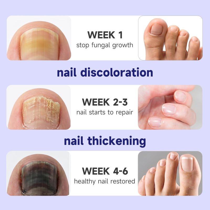 Fingernails Toenail Fungus Treatment extra strength at Home,1 Fl Oz | Deep Restorative Nail Repair for Damaged Nails,Improve Yellowing, Thickening, and Cracking of the nail & Toenail at Home