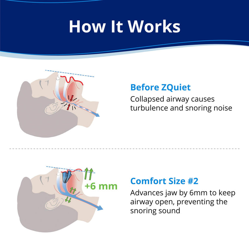 [Australia] - ZQuiet, Anti-Snoring Mouthpiece, Comfort Size #2, Single Refill, Blue Made in USA, BPA-Free, Medical-Grade Material 1 Count (Pack of 1) 