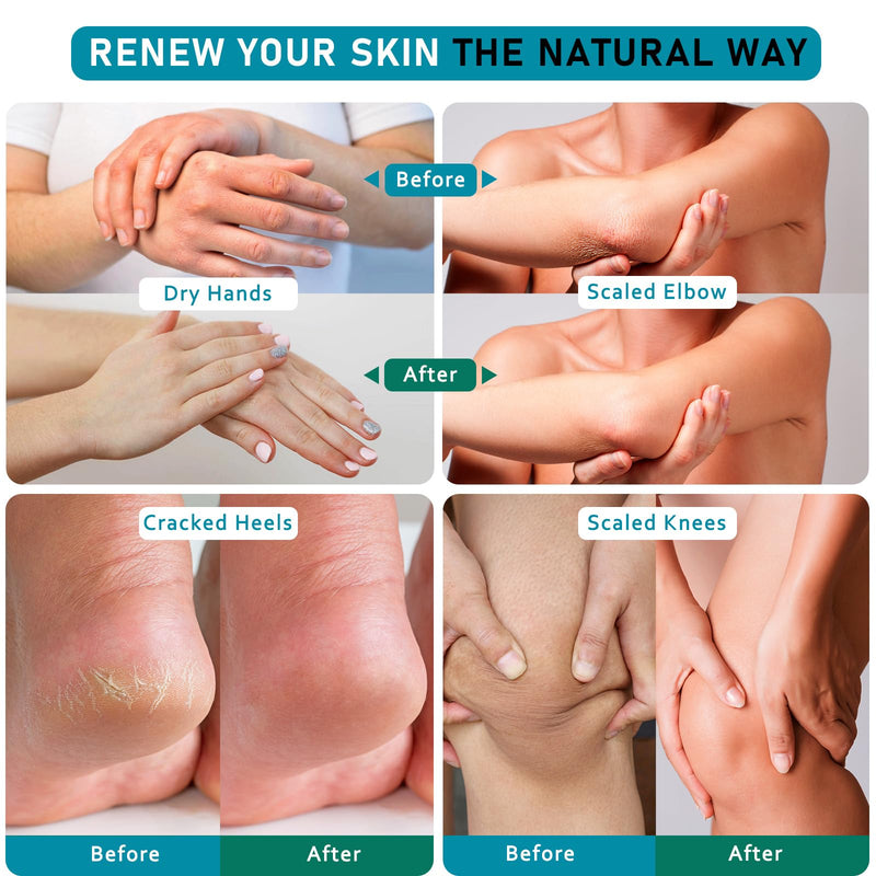 [Australia] - Urea Cream 40 Percent For Feet Maximum Strength - plus Salicylic Acid 2% Foot Cream For Dry Cracked Heels Feet Knees - Dead Skin Cuticle Callus Remover Toenail Softener - Pack of 2 2.65 Ounce (Pack of 2) 