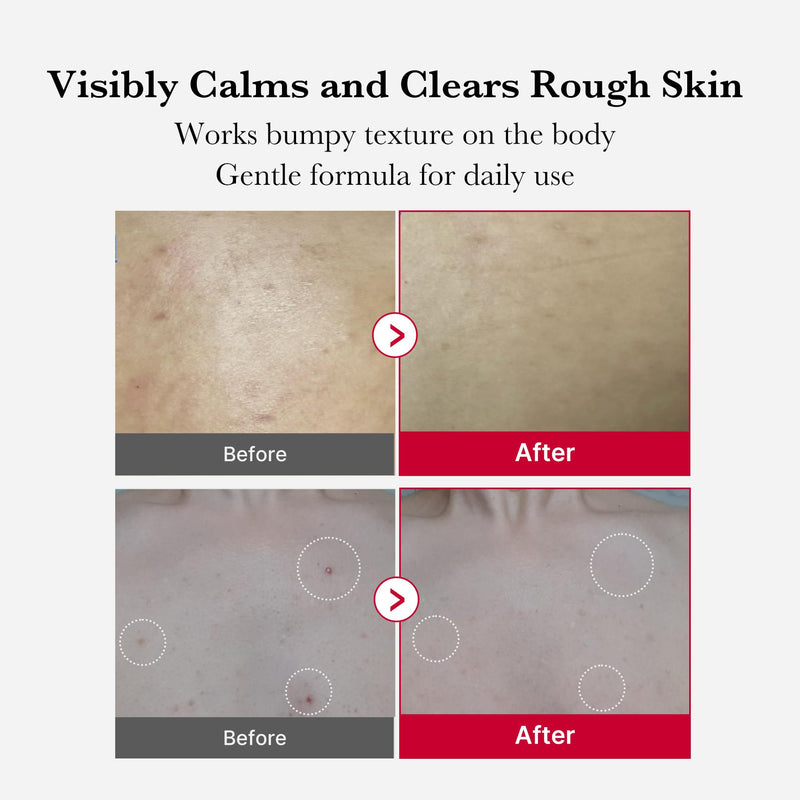 [Australia] - medicube Red Body Peeling Shot, AHA + BHA Exfoliating Body Spray for Summer-Ready Smooth Skin, Treats Strawberry Skin, Bumps & Breakouts, 3.88 oz 