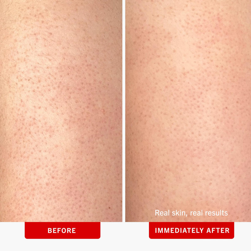 [Australia] - First Aid Beauty - KP Bump Eraser Body Scrub with 10% AHA, Keratosis Pilaris Skin Exfoliater with Glycolic and Lactic acids, Helps Reduce Chicken Skin Bumps, Safe for Sensitive Skin, 10 oz 10 Ounce (Pack of 1) 