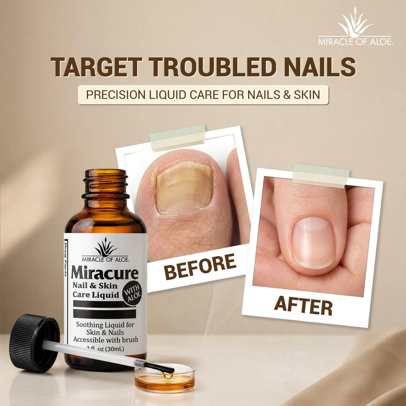 Miracle of Aloe’s UltraAloe Nail Care Liquid, 1 Oz, Brush Applicator | Aloe Based Foot Care For Fingernails, Toenails, Cuticles & Surrounding Skin, Toe Separators, Tea Tree Oil, Odor Control