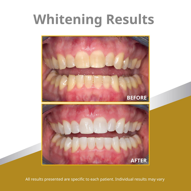 Opalescence 45% Syringes Teeth Whitening Gel with PF - 5359-2T | (4 Syringes) Refill Kit Carbamide Peroxide, Mint Flavor. Ultradent Leaders in Professional Whitening. Includes Toothbrush.