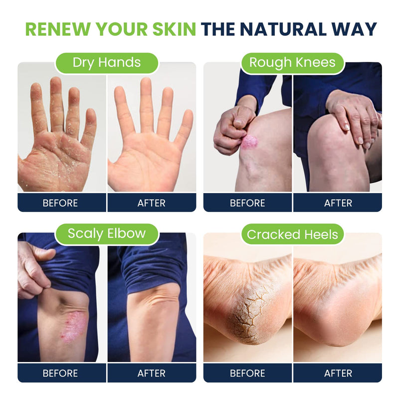 [Australia] - Tea Tree Foot Soak & Callus Remover Gel Kit - Extra Strength Callus Remover Gel & Foot Soak With Epsom Salts For Calluses & Tea Tree Oil Foot Cream - Moisturizing Athletes Foot Care For Dry Feet 