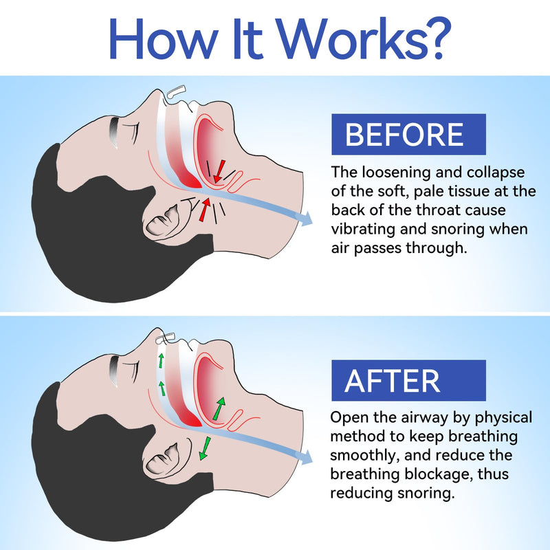 [Australia] - Anti Snoring Devices, Anngola Snoring Solution, Silicone Magnetic Anti Snoring Nose Clip, Effective Hale Breathing Aid, Stop Snoring to Restful Sleep(10 Pack) 