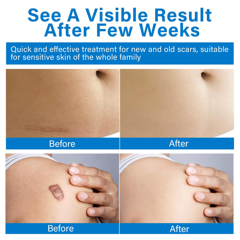 [Australia] - Scar ointment, medical silicone scar cream gel for reduced visible surgical scars, burns, keloid, acne scars, injuries 