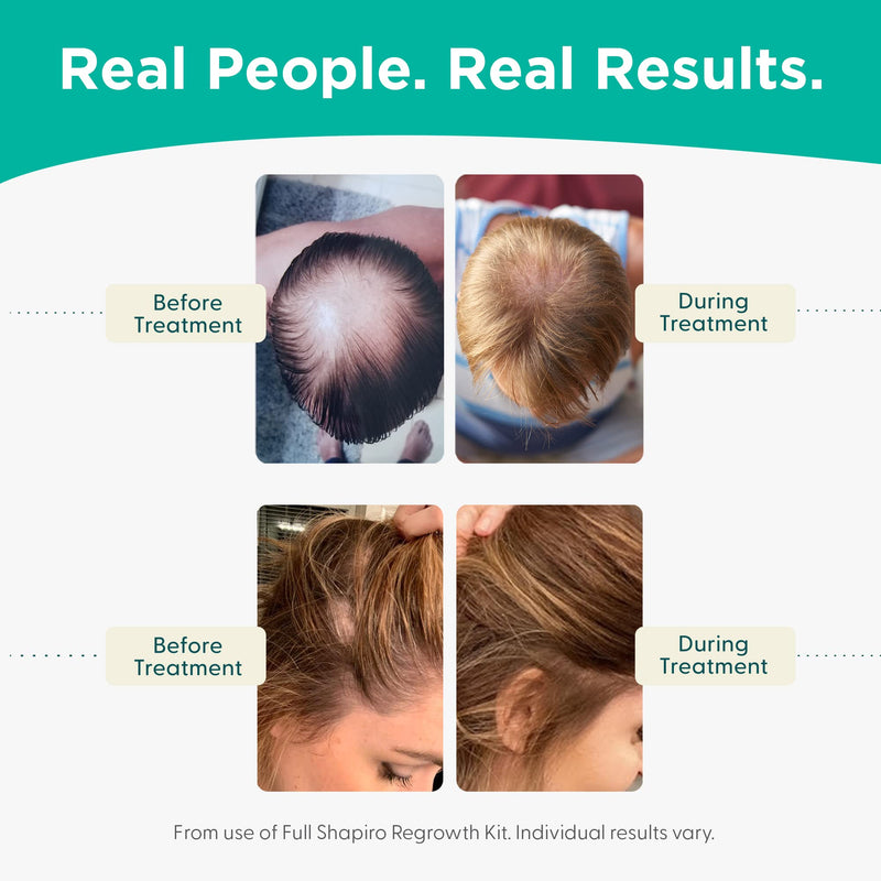 Shapiro MD Hair Growth Experts Vegan Hair Loss Shampoo for Thinning Hair | DHT Fighting Formula Developed by Dermatologists, Experience Healthier, Fuller & Thicker Looking Hair (1 Month) 8 Fl Oz (Pack of 1)