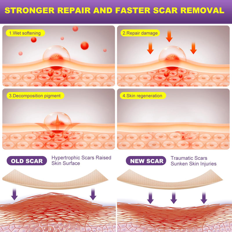 [Australia] - Silicone Scar Sheets, Silicone Scar Tape, Scar Tape for Keloid Bump Removal, Reusable Silicone Scar Strip for C-Section, Keloid, Surgery, Burns, Acne Scar et(1.6‚Äùx60‚ÄùRoll-1.5M) 1.5M (Pack of 1) 