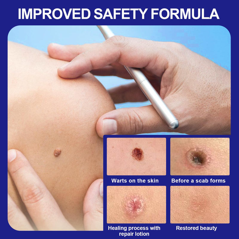 [Australia] - 30 ml skin tag remover, stalk warts removal quickly, skin tag remover kit, easy and convenient for most body parts, leaves the skin smooth 