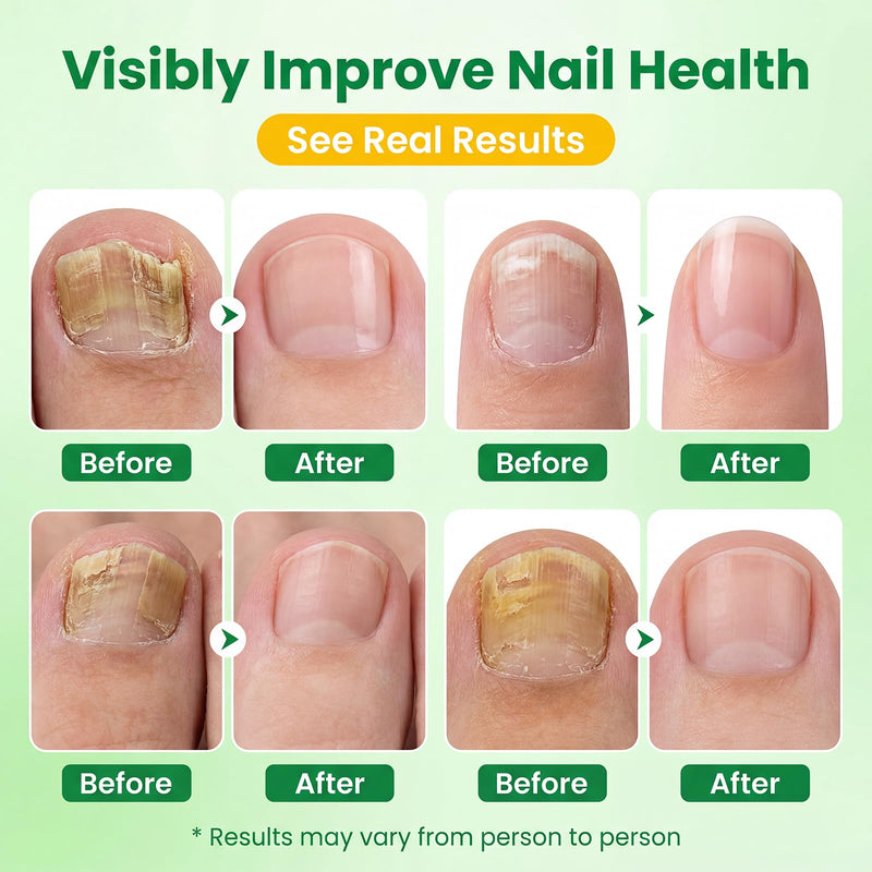 High capacity Nail Pen-16 ml per unit,Toenail Pen Treatment