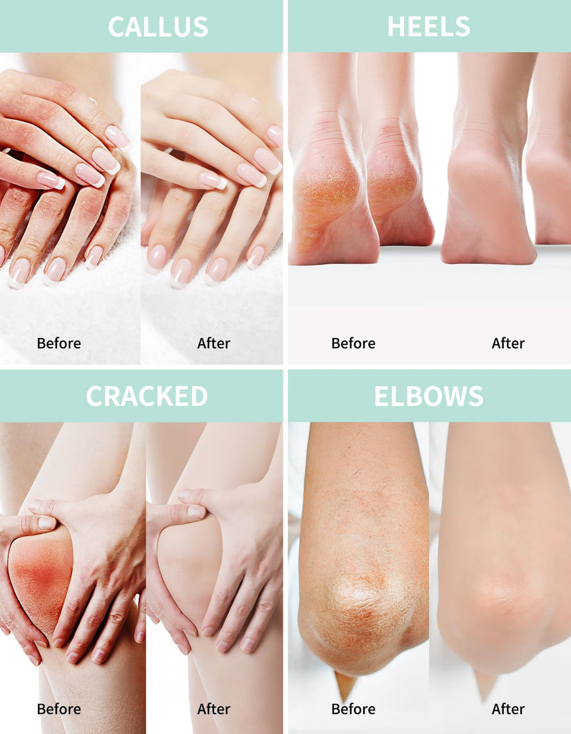 Grocerism Urea Cream 40% for Feet Maximum Strength Hand & Foot Cream 8.82oz | with 2% Salicylic Acid, Aloe Vera & Hyaluronic Acid, for Cracked Heels, Calluses & Rough Dry Skin 8.82 Ounce (Pack of 1) 40%
