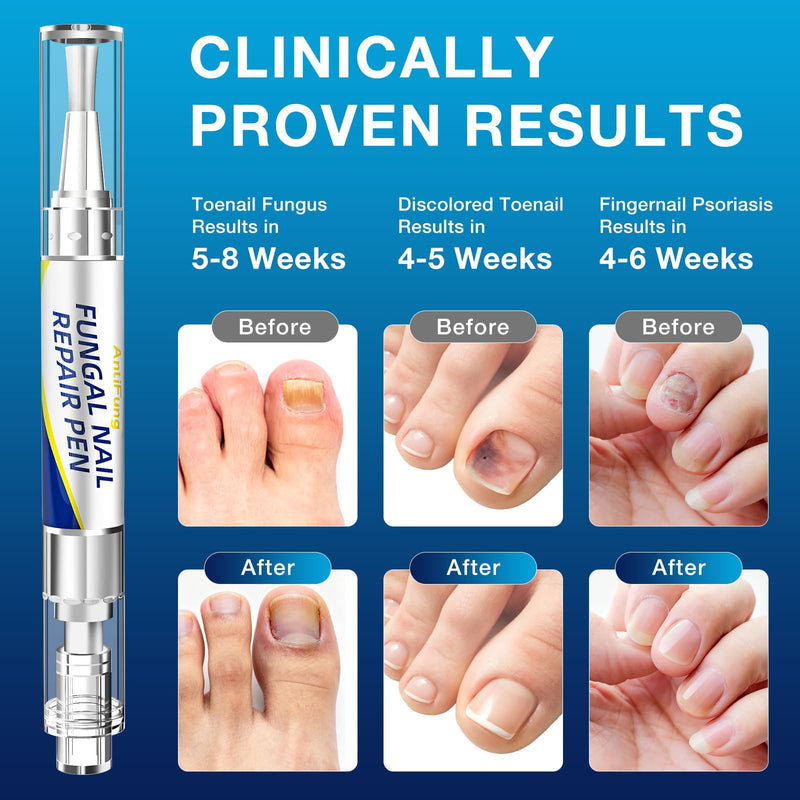 Toenail Fungus Treatment Extra Strength - AntiFung Pen - Maximum OTC with 25% Undecylenic Acid - for Damaged Nails, Ingrown Nails & Discoloration - 3-Pack Applicator Pen 1 Fl Oz (Pack of 3)