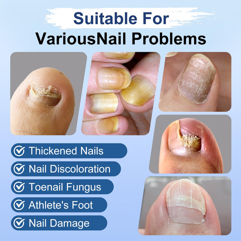 Toenail Fungus Treatment Extra Strength, Fungi Nail Pen, 25% Undecylenic Acid, Ingrown toenail treatment, Repairs Yellow Thick Brittle Toe and foot fungus treatment extra strength - 9Pcs