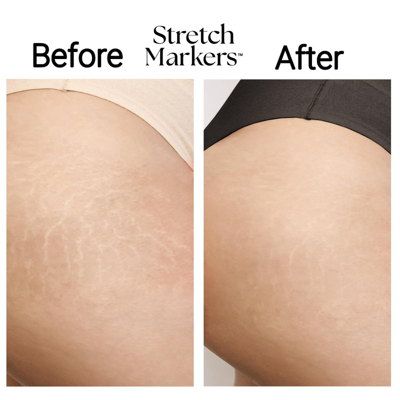 [Australia] - StretchMarkers Therapy Visibly Reduce and Treat Stretch Marks Cream, 1 fl oz, Retinol, Hyaluronic Acid, Bioactive Peptides & 3D Stem Cell Technology 