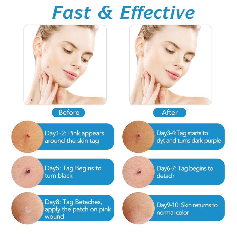 [Australia] - Skin tag remover, auto skin tag remover kit, 2-in-1 stalk wart removal quick kit, safe and pain-free, 2-8 mm bands with 40 tag bands & 36 skin tag removal patches 87-piece set 