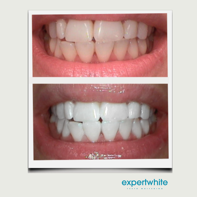 [Australia] - Extreme 44% Teeth Whitening Gel (6-gels) 