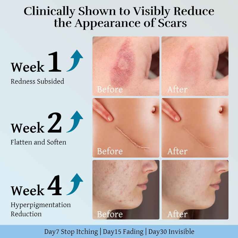 [Australia] - Advanced Scar Cream, Scar Reduction Treatment for Improves Skin Texture & Helps Remove Acne, Stretch Marks, Surgery, C Section, Burn, Keloid & Hypertrophic Scars 1.76 Oz (50g) 
