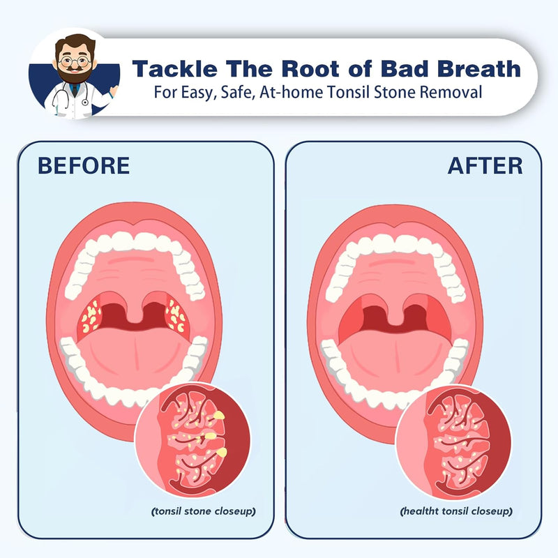 [Australia] - Tonsil Stone Remover Vacuum Electronic Tonsil Stone Removal Kit Instant Suction Tool Oral Irrigator Tonsil Stones Syringe Tongue Depressor 5X Magnifying Mirror 3 Modes Easy to Use Green 