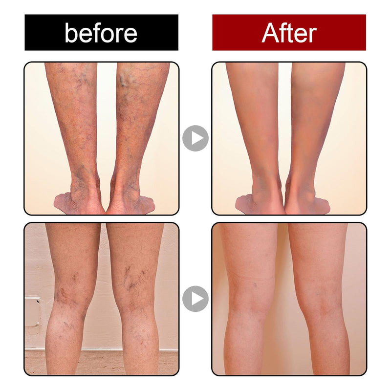 [Australia] - Grgowe Varicose Veins Cream, Varicose Veins Cream, Cream for Spider Veins, Active Veins, Anti-Varicose Veins Cream, Cream for Relieving and Preventing Varicose Veins, Improve Blood Circulation for Legs 