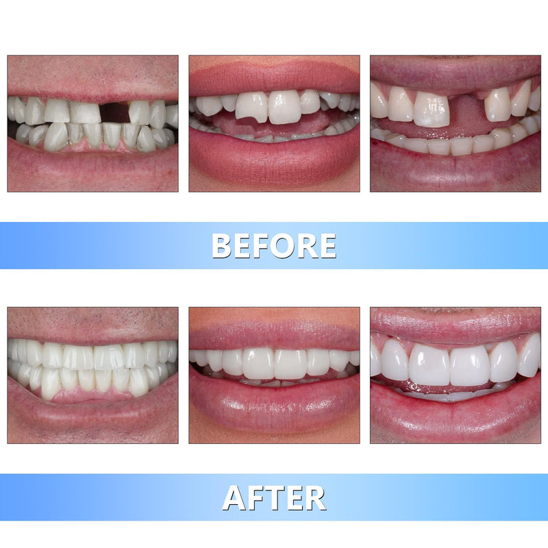 [Australia] - Tooth Repair Kit, Moldable False Teeth, DIY tooth thermoplastic beads Temporary Tooth for Replacing Missing & Broken Teeth with 4 Dental Tool, Regain Your Confidently Smile 30 ML 