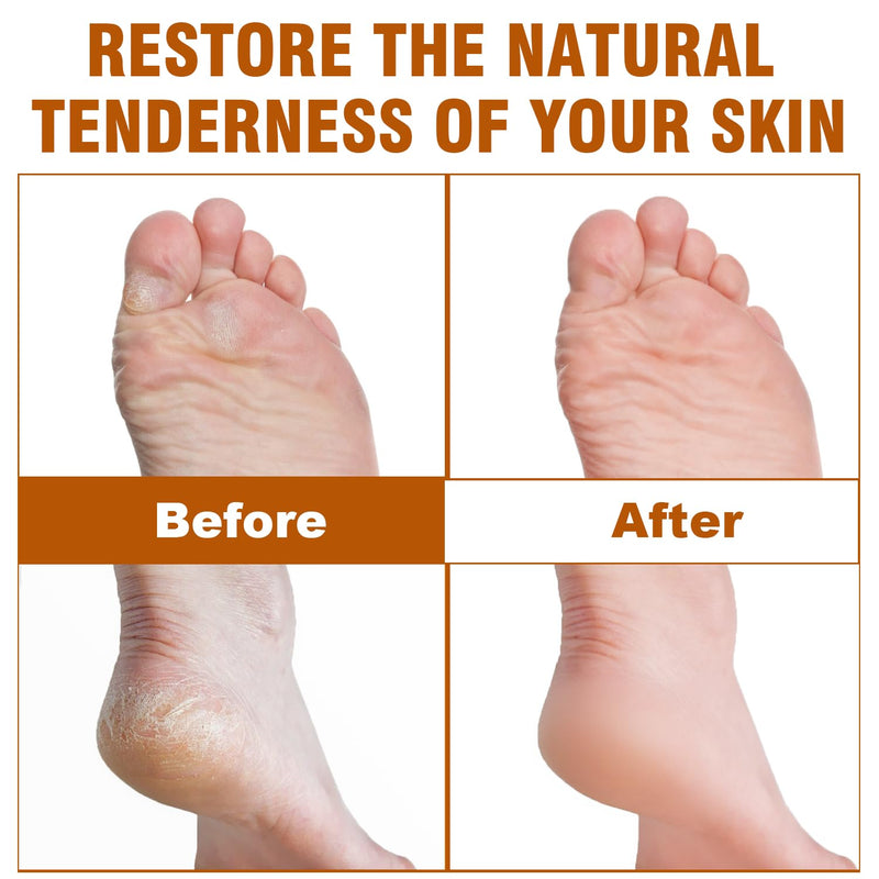 60% Urea Foot Cream with 2% Salicylic Acid for Dry Cracked Heels, Organic Tea Tree Feet Callus Repair Lotion, Maximum Strength Moisturizer with Hyaluronic Acid & Ceramides for Dry, Rough Skin