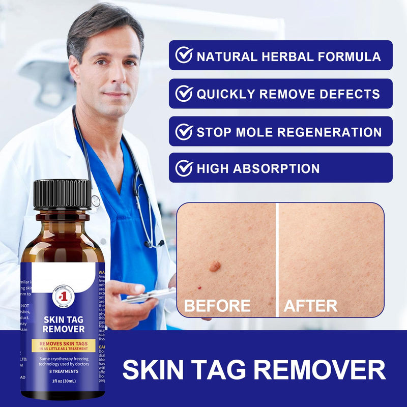 [Australia] - 30 ml skin tag remover, stalk warts removal quickly, skin tag remover kit, easy and convenient for most body parts, leaves the skin smooth 