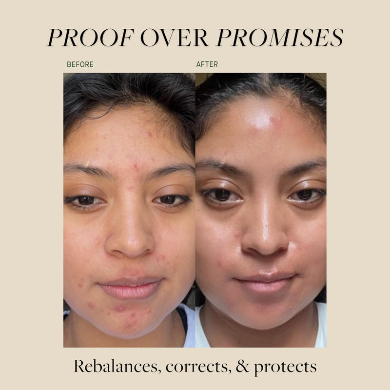 Kat Burki VitaBiome Active Skin Optimizer, Clarifying Face Mist | Advanced Prebiotic Clearing & Redness Relief Face Mist for Breakout-Prone Skin, Rebalances the Microbiome with Ginseng Root 1 Fl Oz