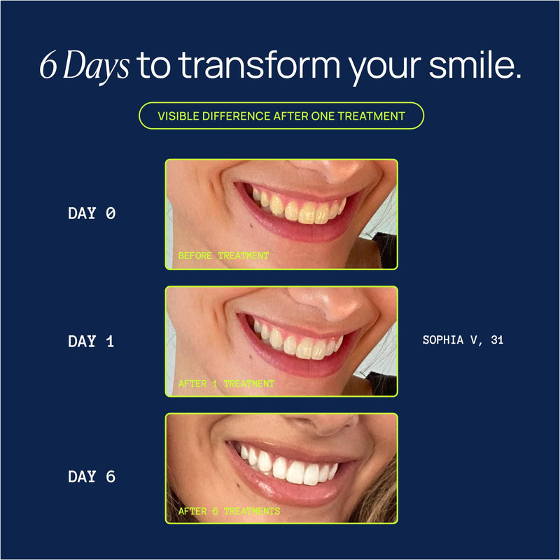 [Australia] - Super Strength Teeth Whitening Kit, LED Mouthpiece, 3 Whitening Gel Syringes, 11% Hydrogen Peroxide, Glycerin, Aloe Vera & Mint, at Home Dental Care, 6+ Treatments Super Strength 1 Count (Pack of 1) 