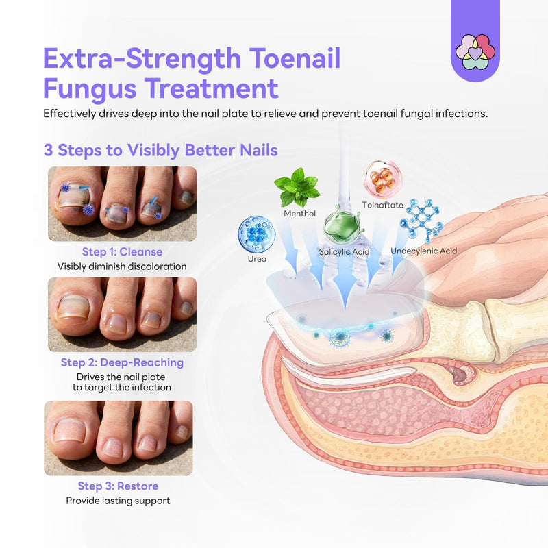 SAVILAND Toenail Fungus Treatment for Thick Discolored Damaged Nails 2oz | FSA-HSA, Max 25% Undecylenic Acid & 1% Tolnaftate, With Salicylic Acid & Vitamin E, Daily At-Home Use, Includes File & Swabs