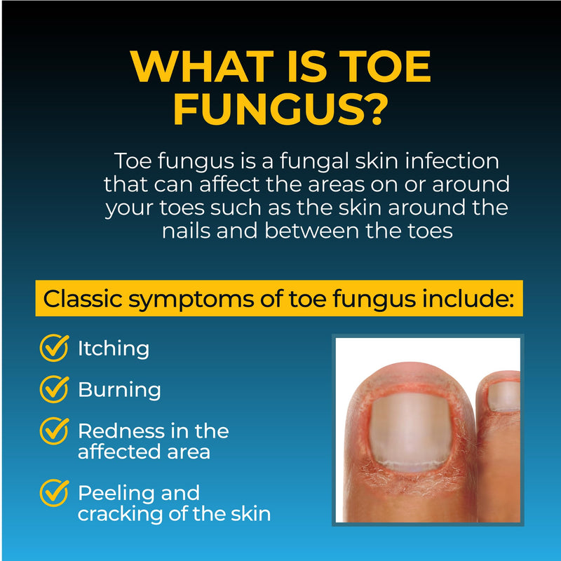 Fungi-Nail Anti-Fungal Liquid Solution, 1 Fl Oz | Kills Toe Fungus with Tolnaftate & Clinically Proven to Cure and Prevent Fungal Infections 1 Fl Oz (Pack of 1)