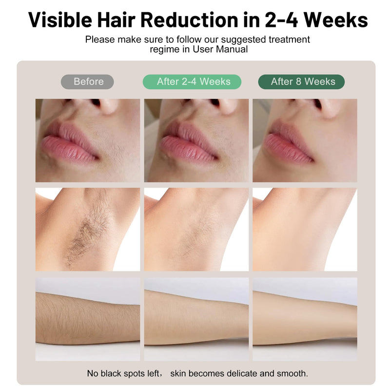 [Australia] - Laser Hair Removal, IPL Hair Removal Device with Cooling Function, Safe, Long-lasting and Virtually Painless Treatment, Unlimited Flashes at Home Use 