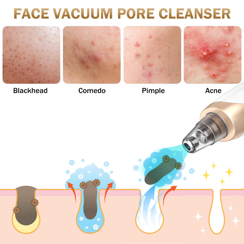 Blackhead Remover Pore Vacuum Kit -Blackhead Extractor Tool with 3 Adjustable Suction Levels, 5 Probes, USB Rechargeable, Suitable for Women and Men(White) White